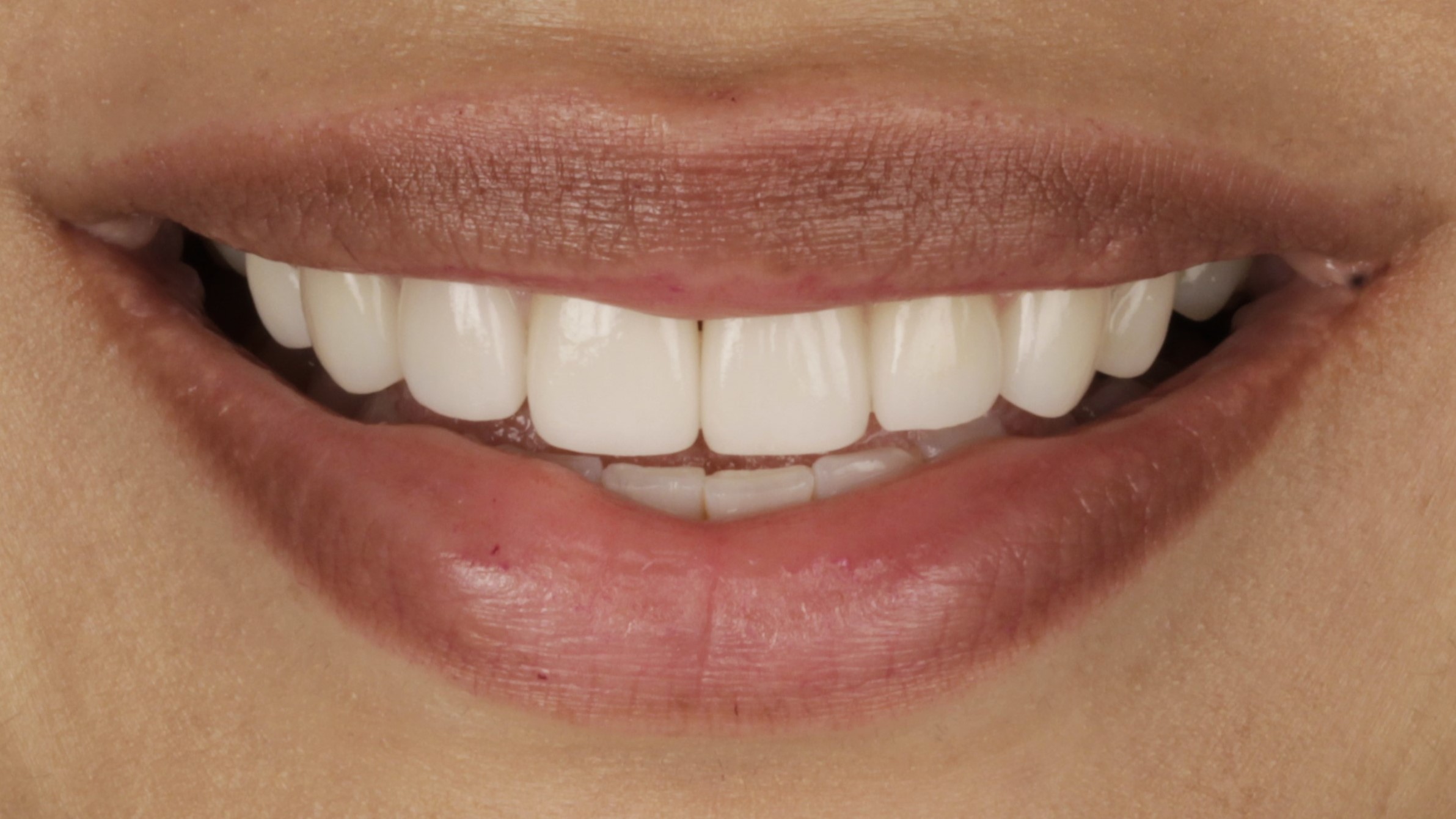 After: porcelain veneers