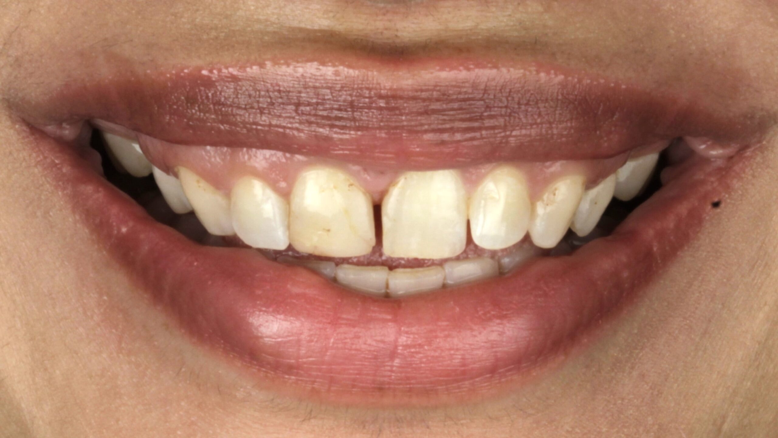 Before: chipped and deeply stained teeth