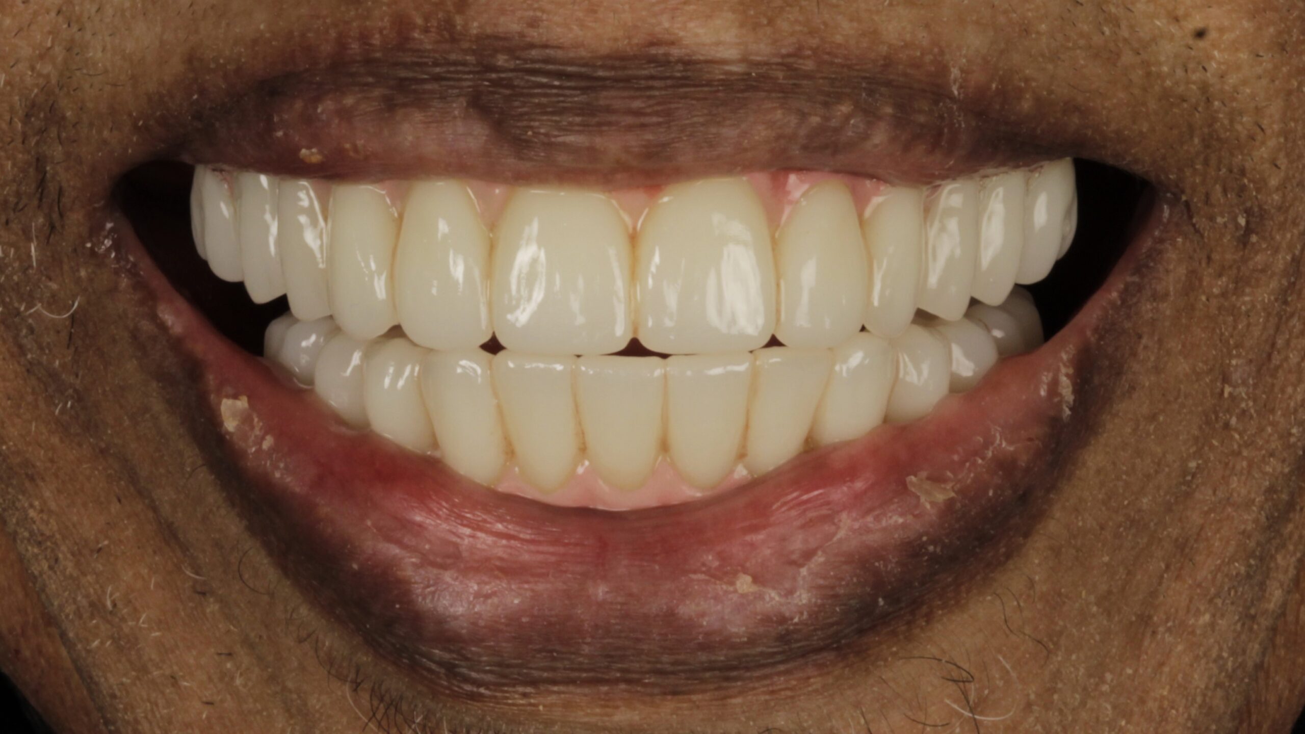 A completed full-arch implant restoration
