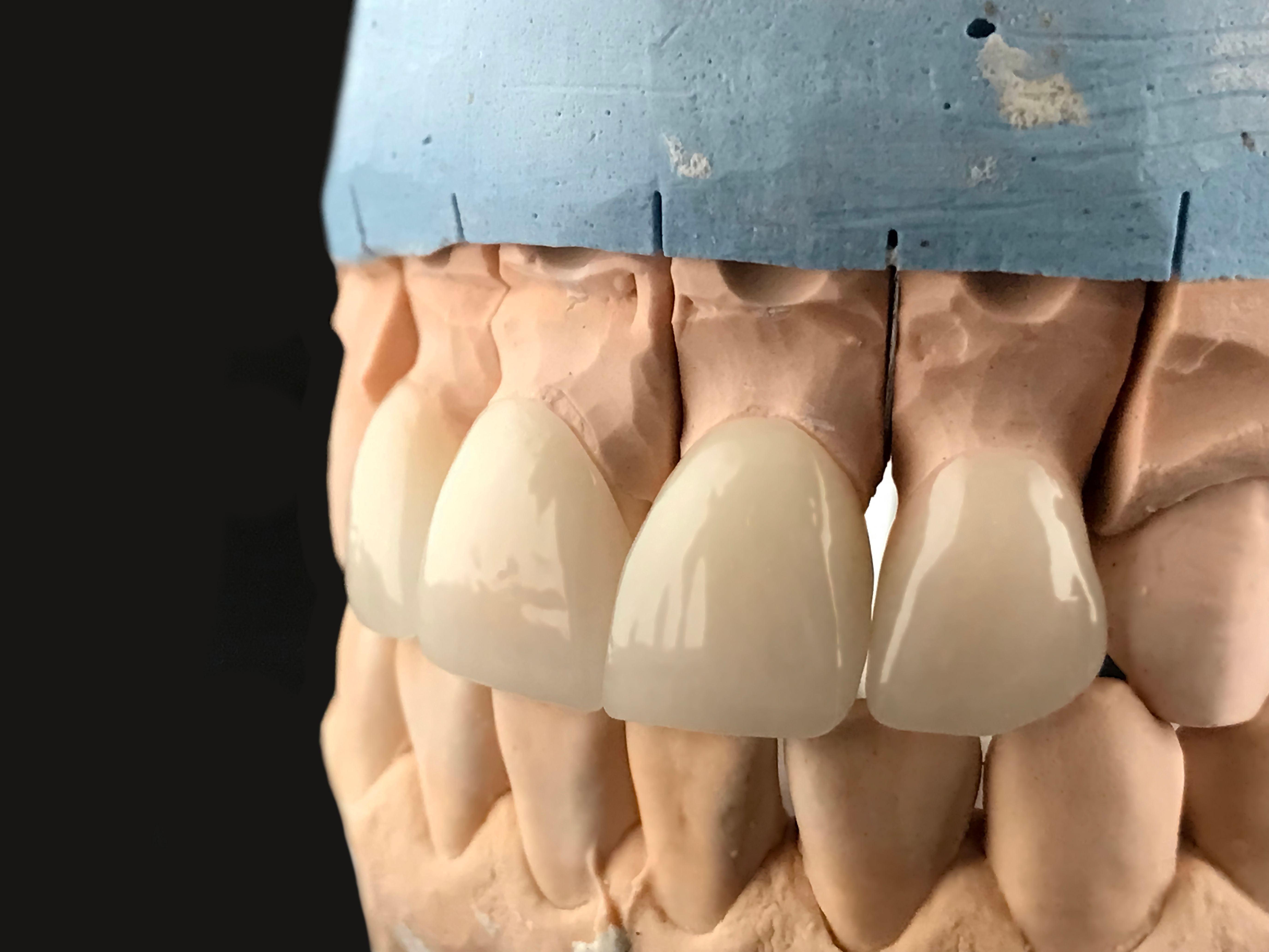 Close-up of lab-made ceramic front-tooth crowns fitted on a stone model of the patient's teeth