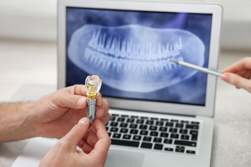 A clinician showing a patient their X-ray beside an implant model