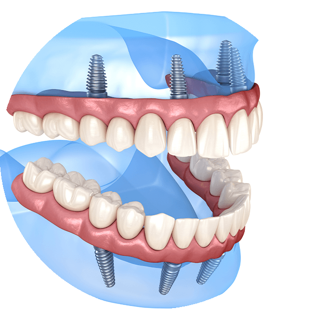 Four implants carrying a full arch