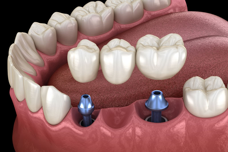 An abutment and crown on an implant post