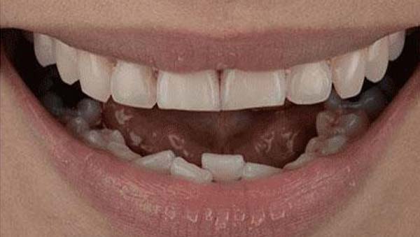 Before: worn and discolored front teeth