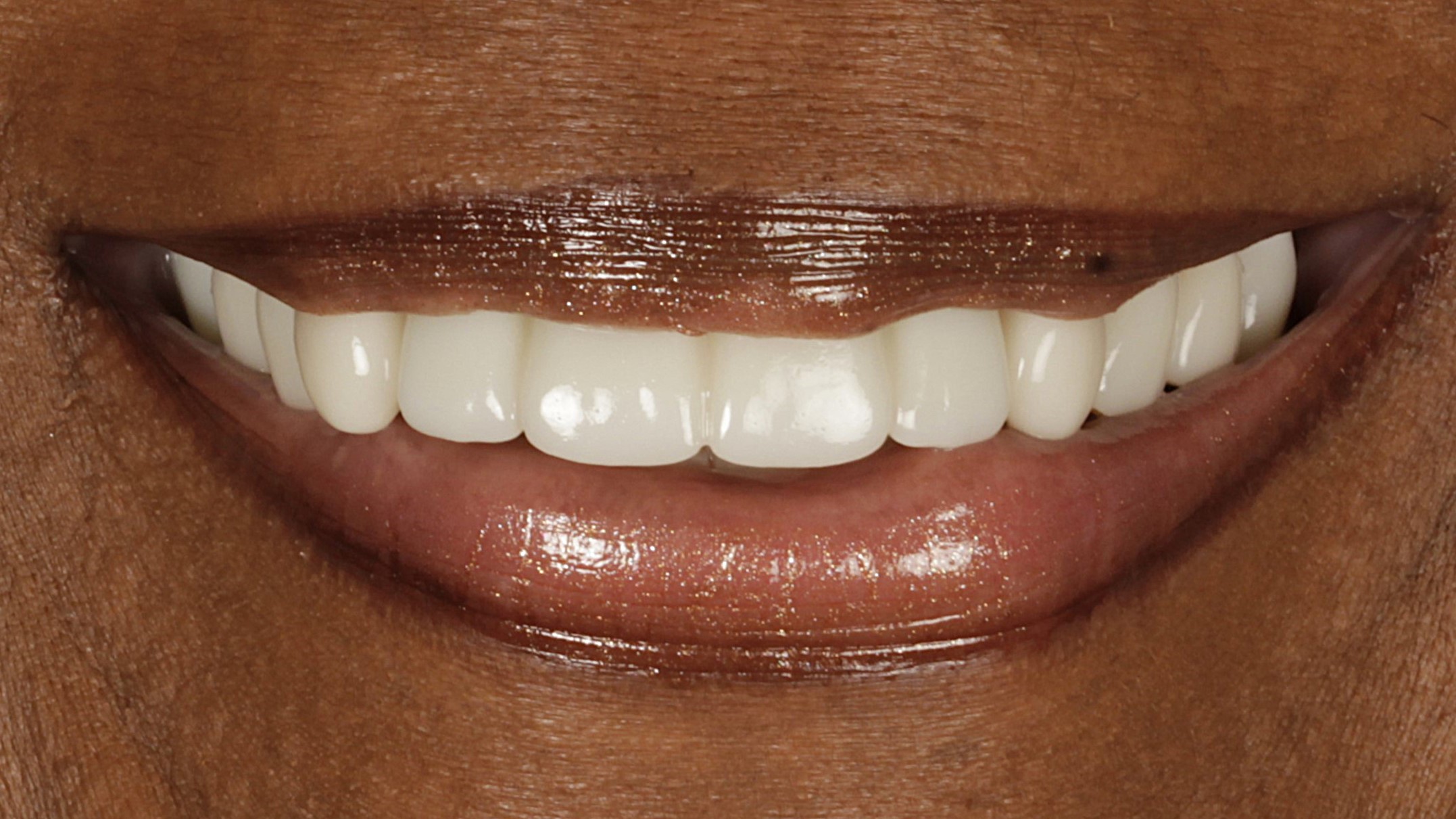 After: veneers combined with implants