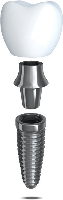 A titanium implant post placed in the jaw