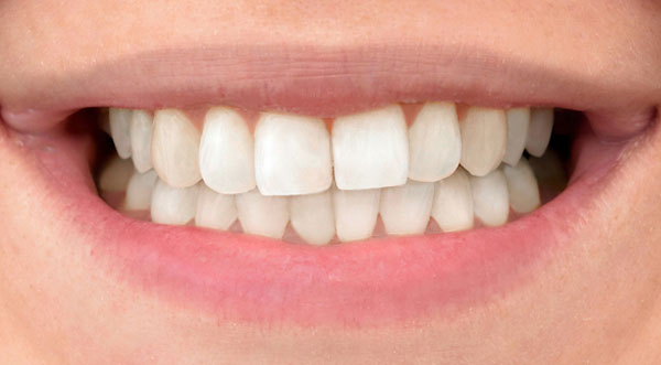 After: professional whitening