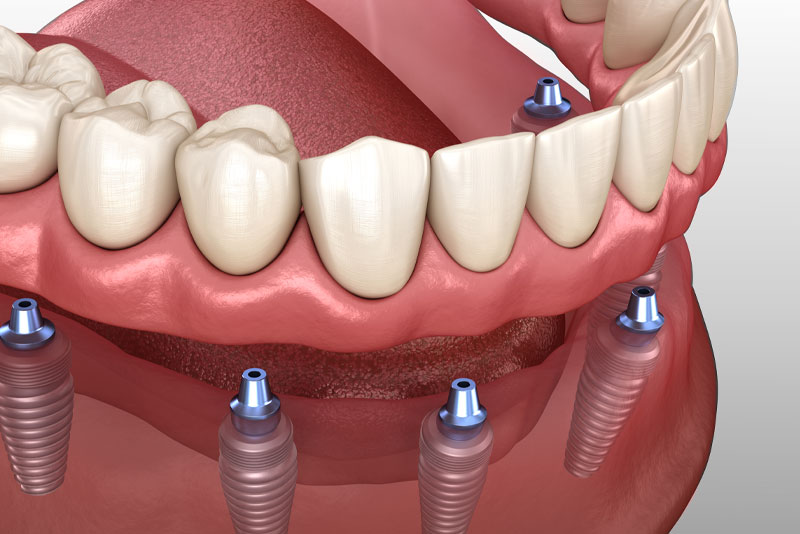 A denture clipped onto implant locators