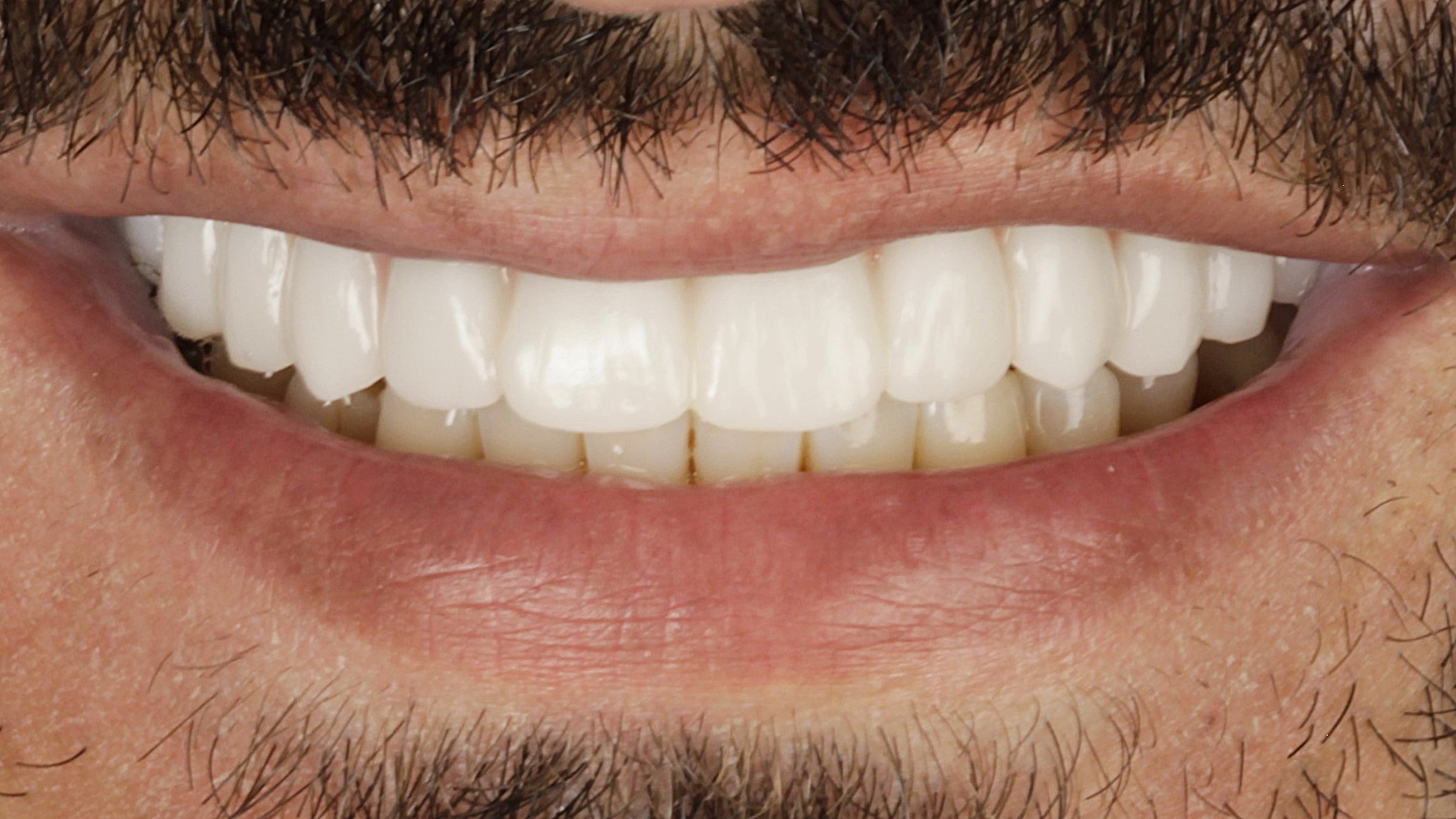 After: single-arch implant restoration