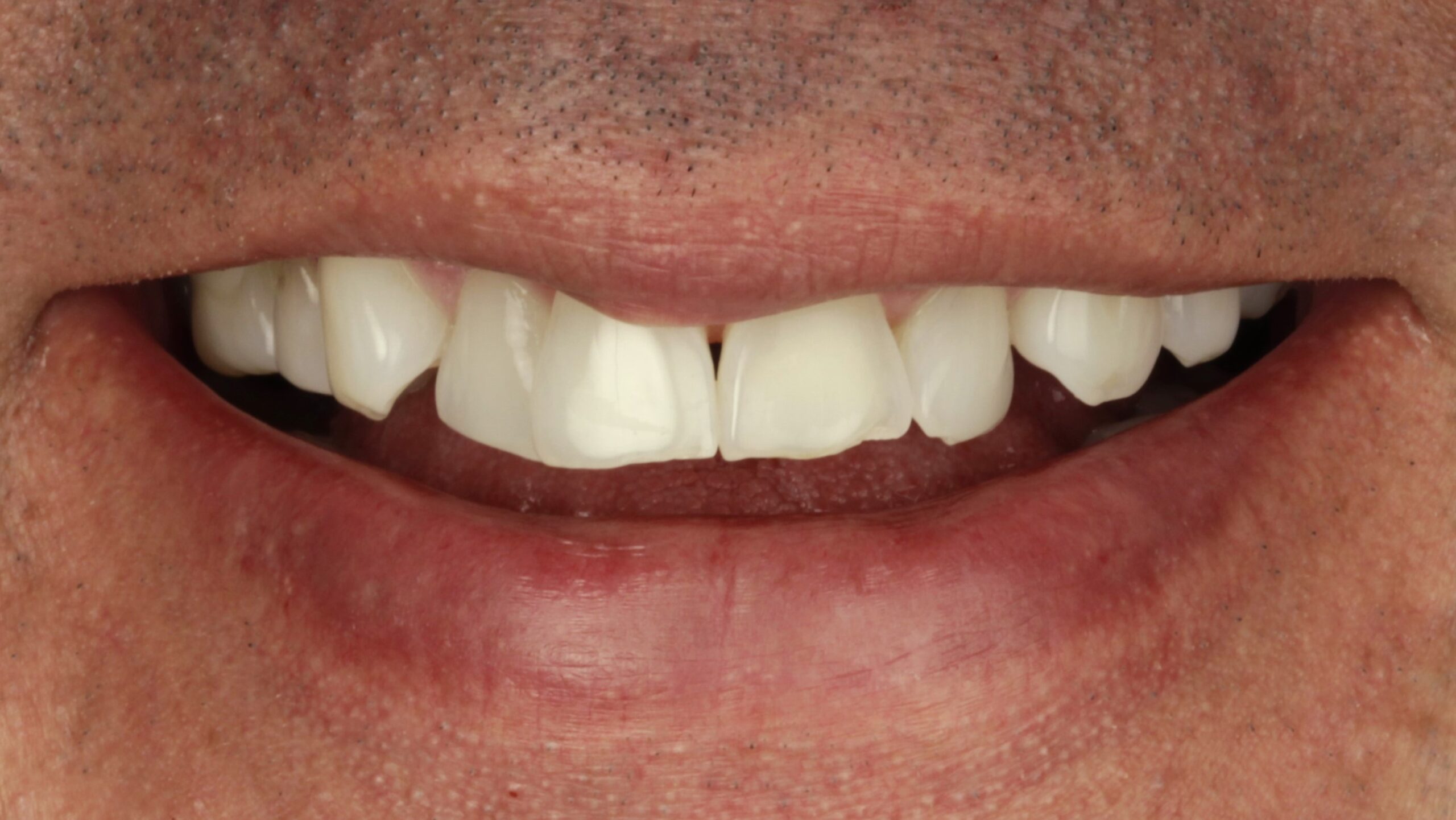 Before: uneven tooth shape and proportion