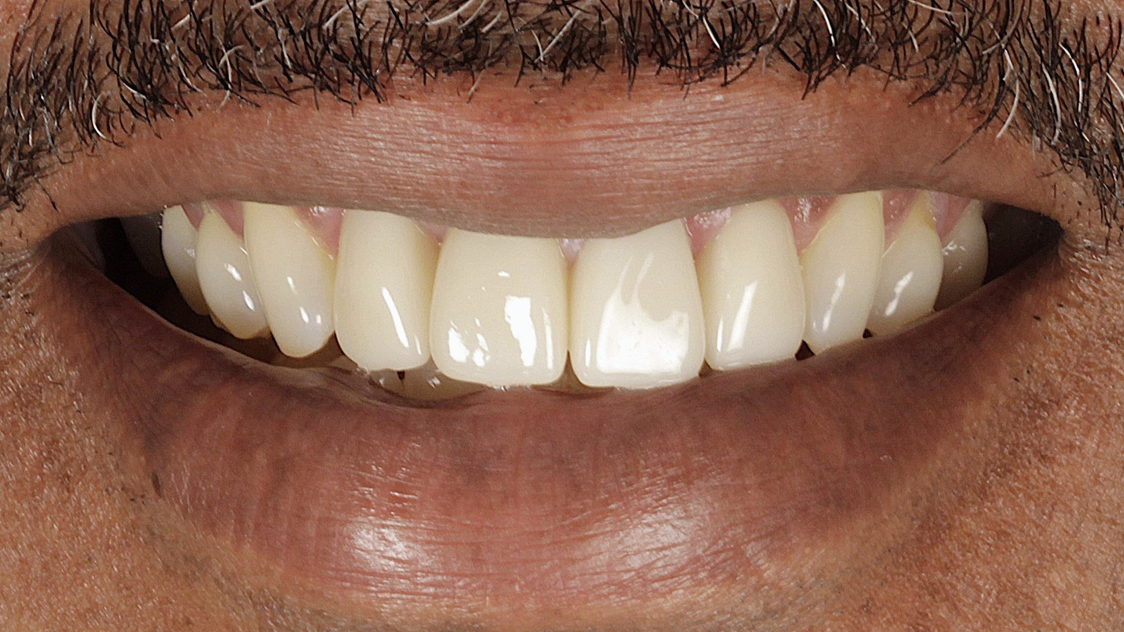 Veneers combined with implant restoration