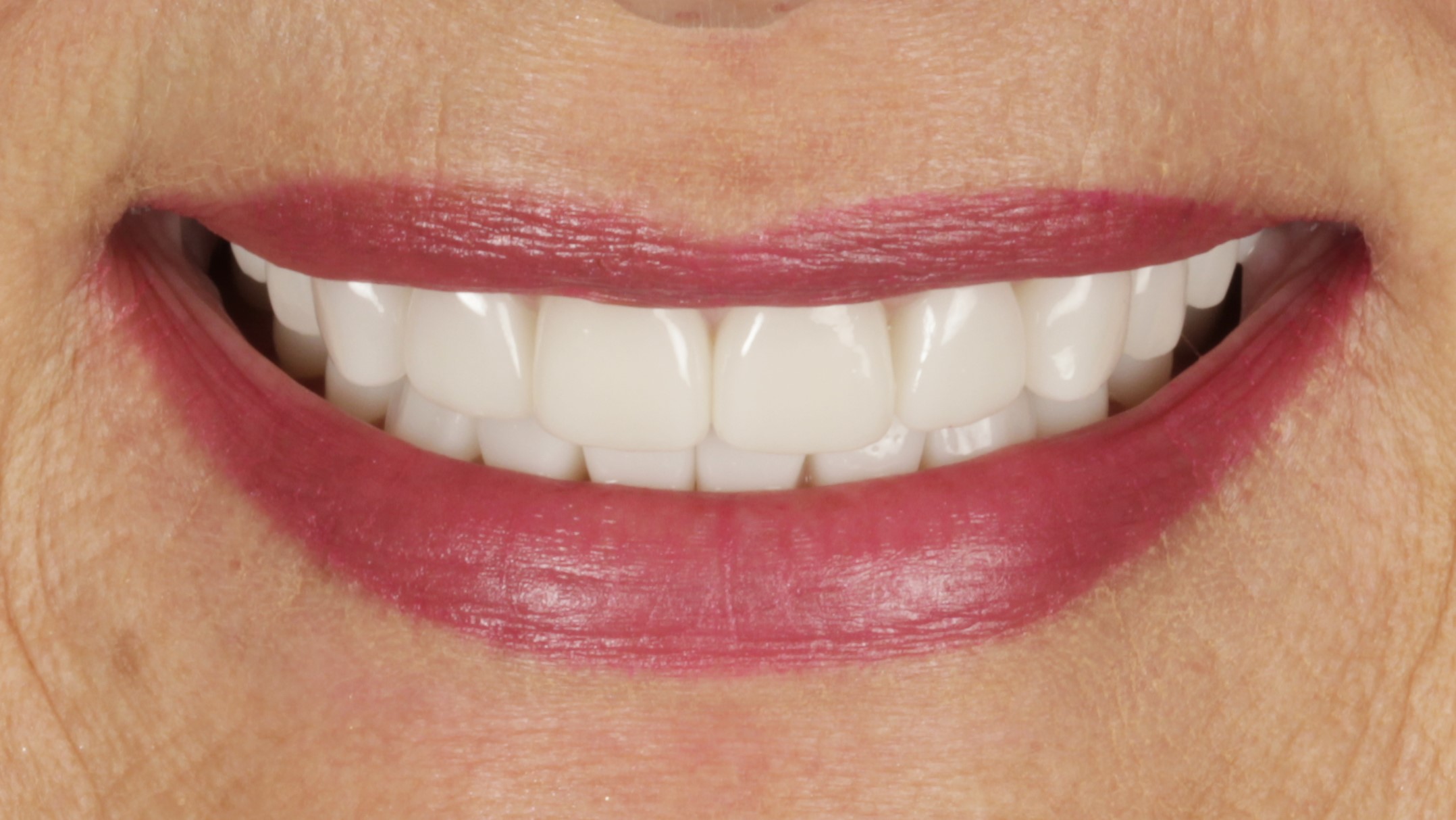 A completed porcelain veneer case