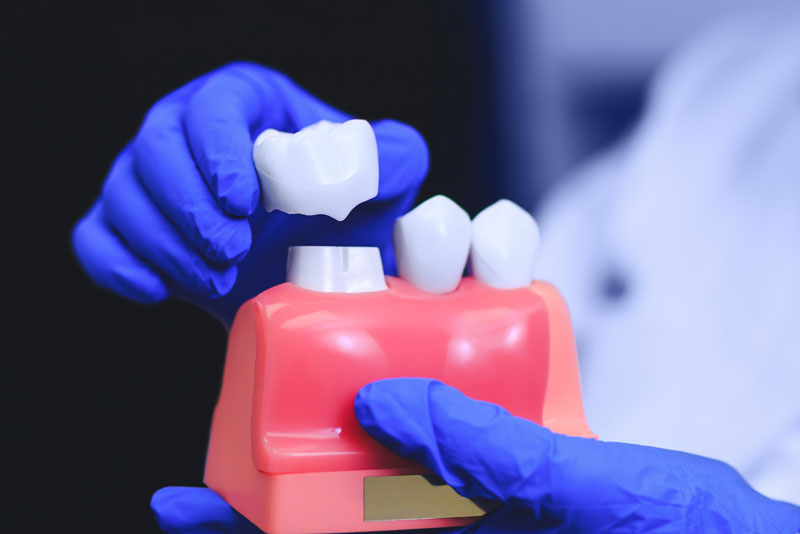 An inlay restoration on a molar