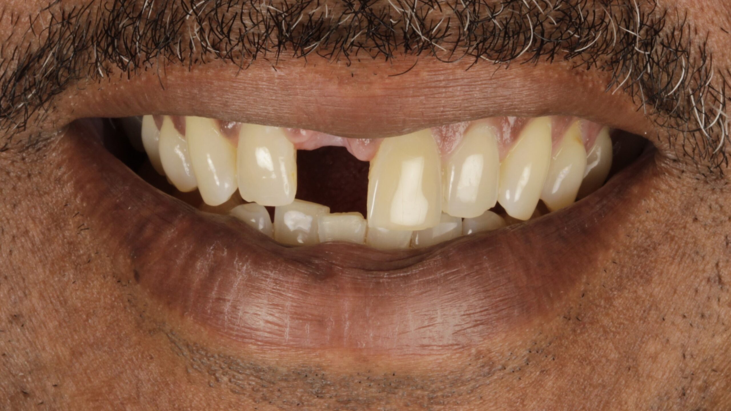 Before: failing front teeth