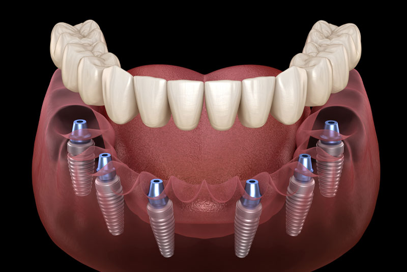 A jaw model showing implant sites in the bone