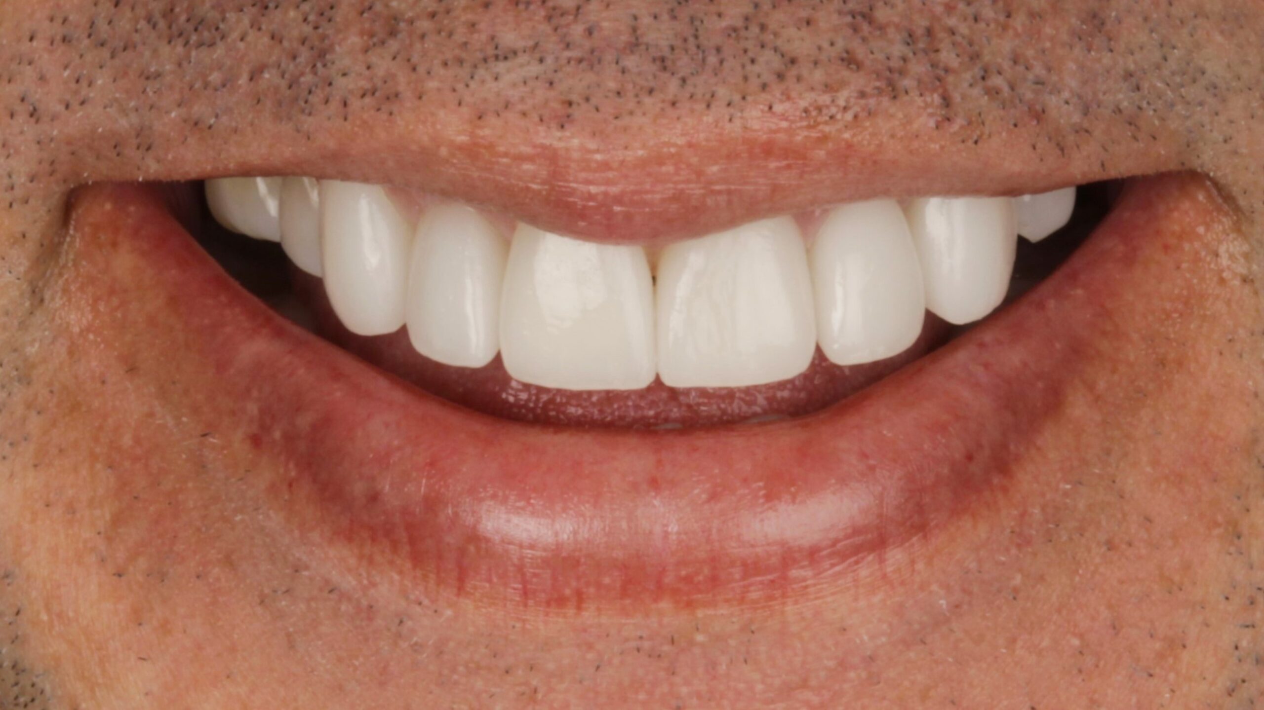 After: porcelain veneers
